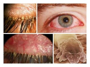 Symptome von Parasiten unter der menschlichen Haut